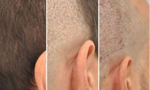 Scalp Micropigmentation Scalp Micropigmentation